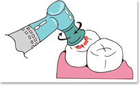 ２．歯の表面の研磨