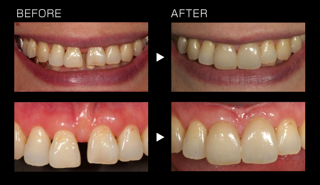 審美・ホワイトニング | 鹿児島の歯医者なら、馬場デンタルクリニック