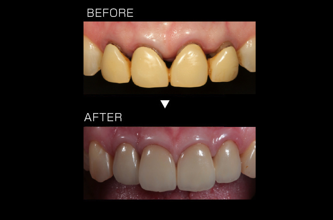 歯周形成外科＋セラミッククラウン＋コンポジットレジン修復