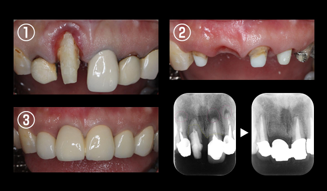 部分矯正＋歯周形成外科(結合組織移植)＋ブリッジ