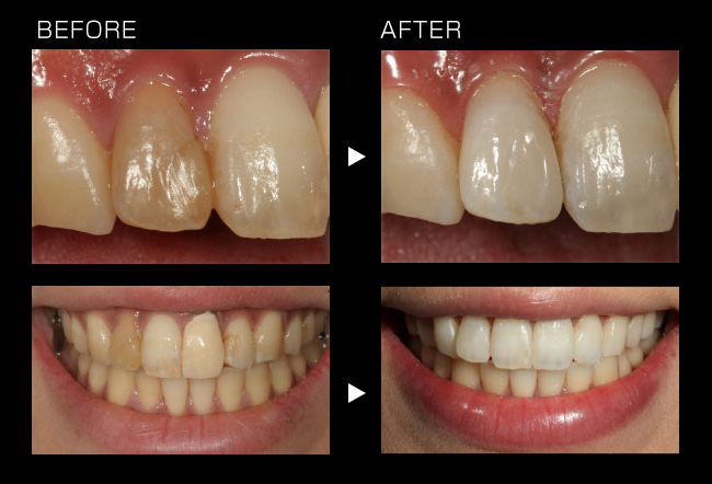 失活歯(神経の無い歯)のホワイトニング＋全体のホワイトニング＋コンポジットレジン修復＋セラミッククラウン