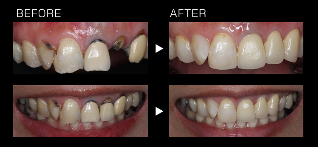 歯冠長延長術＋ダイレクトボンディング(コンポジットレジン)＋オールセラミッククラウン